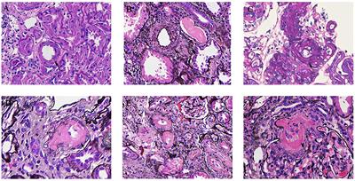 Arterial-Arteriolar Sclerosis Is Independently Associated With Poor Renal Outcome in IgA Nephropathy Patients